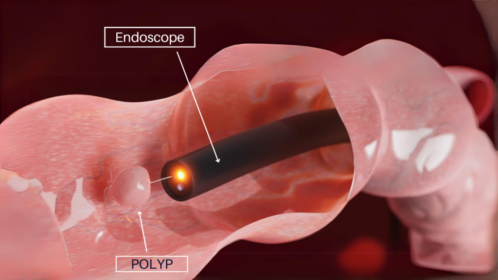 AI generated image of an endoscope inside human body