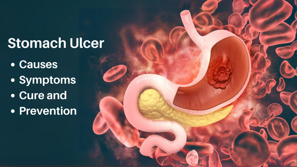 Stomach Ulcer: Causes, Symptoms, Cure and Prevention