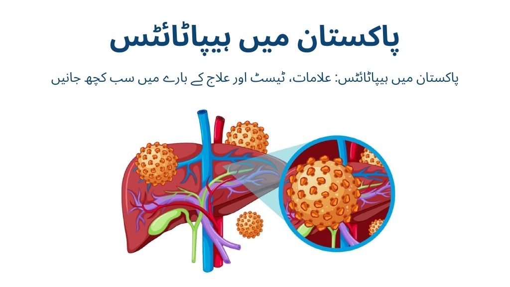 پاکستان میں ہیپاٹائٹس